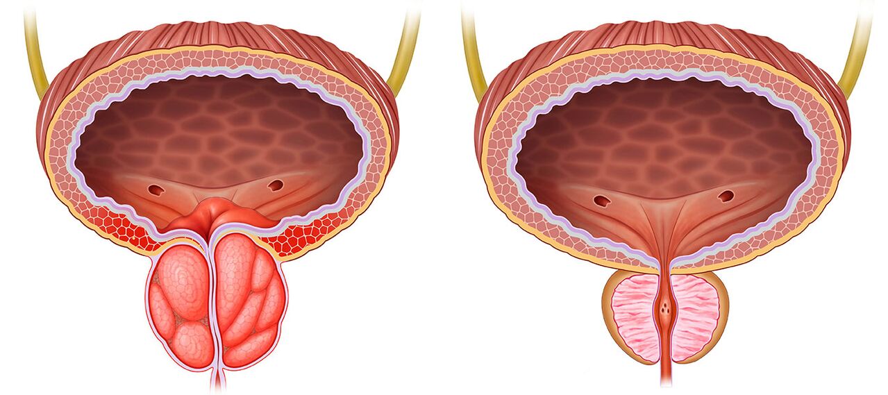 Entzündete und gesunde Prostata nach der Verwendung von Prädstonorm -Kapseln